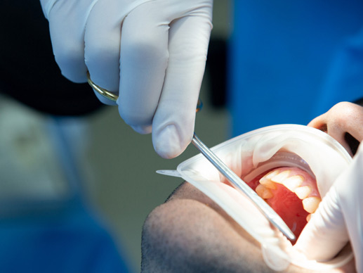 Apicoectomy And CYST Treatment