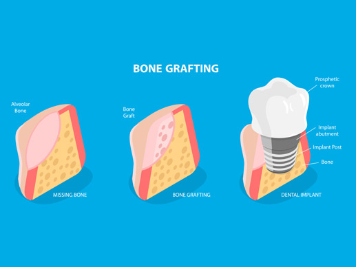 Bone Graft and Sinus Lift
