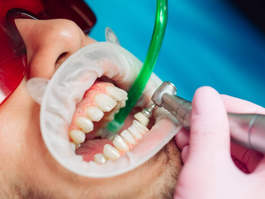 Dental Cleaning and polishing