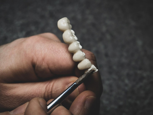 Dental Crowns, Inlays, Onlays and Bridges