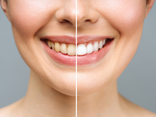 At Home And In Office Teeth Whitening